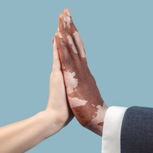 O que é vitiligo?