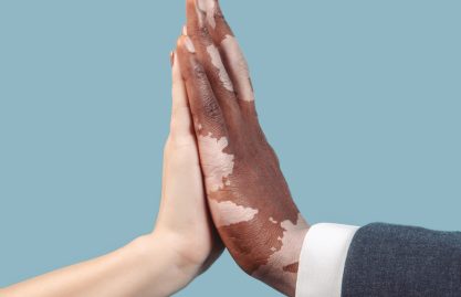 O que é vitiligo?